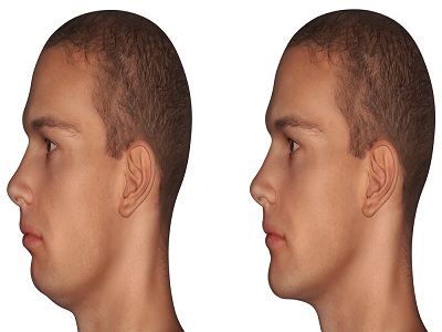 Chin augmentation surgery 